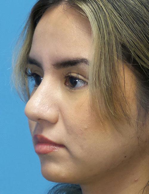Crispin Plastic Surgery rhinoplasty after — Atlanta, GA