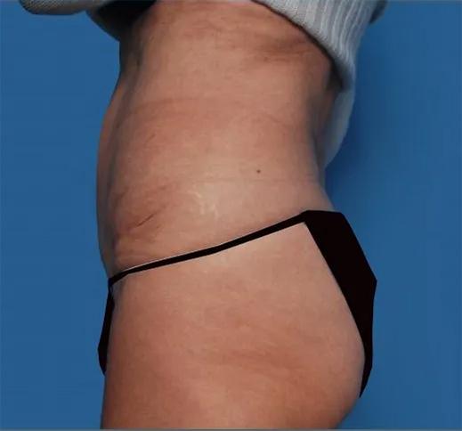 Tummy Tuck after at Crispin Plastic Surgery in Atlanta, GA