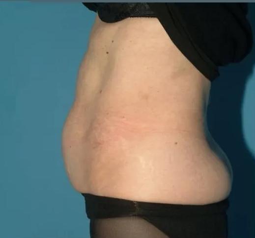 Tummy Tuck before at Crispin Plastic Surgery in Atlanta, GA