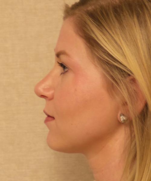Crispin Plastic Surgery rhinoplasty after — Atlanta, GA