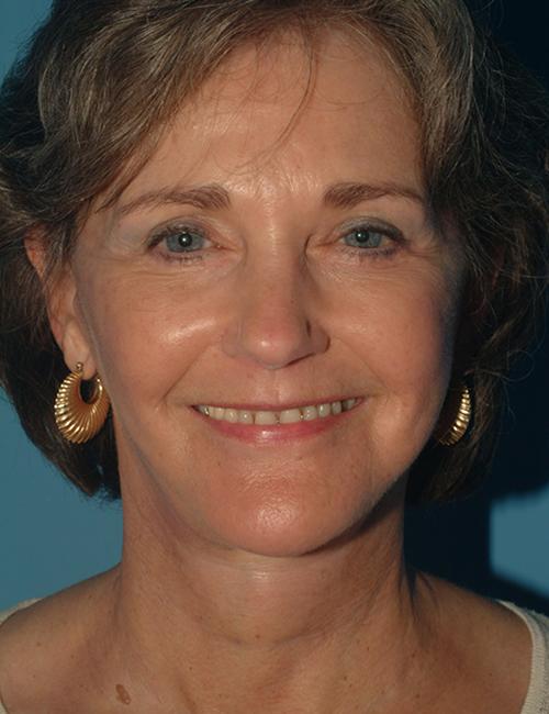 Crispin Plastic Surgery facelift after — Atlanta, GA