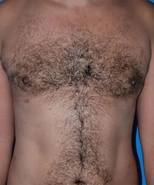 Gynecomastia Surgery after at Crispin Plastic Surgery in Atlanta, GA