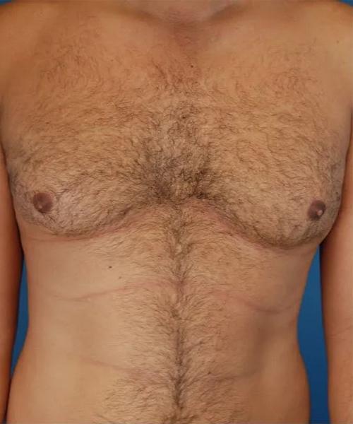 Gynecomastia Surgery before at Crispin Plastic Surgery in Atlanta, GA
