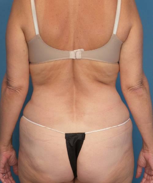 Crispin Plastic Surgery liposuction after — Atlanta, GA