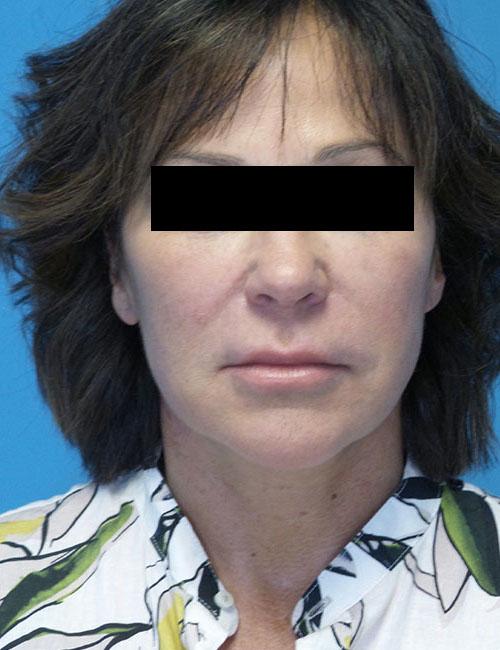 Crispin Plastic Surgery neck lift after — Atlanta, GA