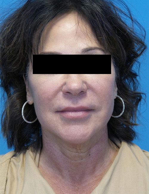 Neck Lift before at Crispin Plastic Surgery in Atlanta, GA