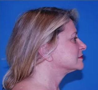 Facelift after at Crispin Plastic Surgery in Atlanta, GA