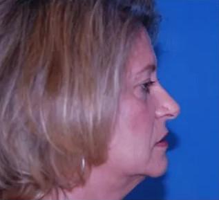 Facelift before at Crispin Plastic Surgery in Atlanta, GA