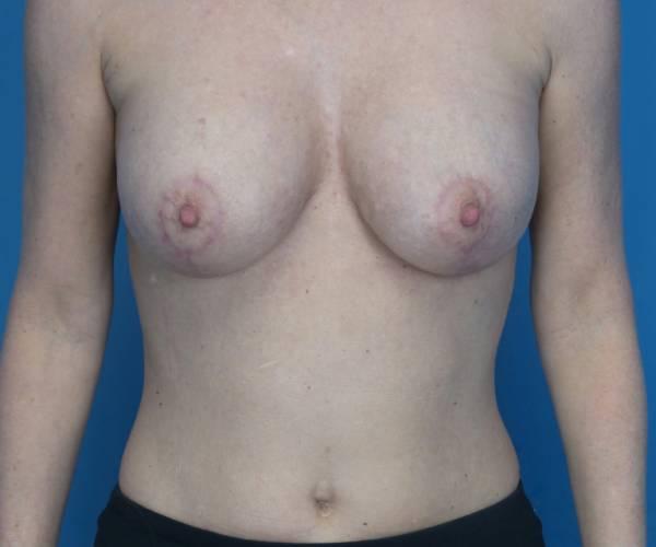 Crispin Plastic Surgery breast lift after — Atlanta, GA