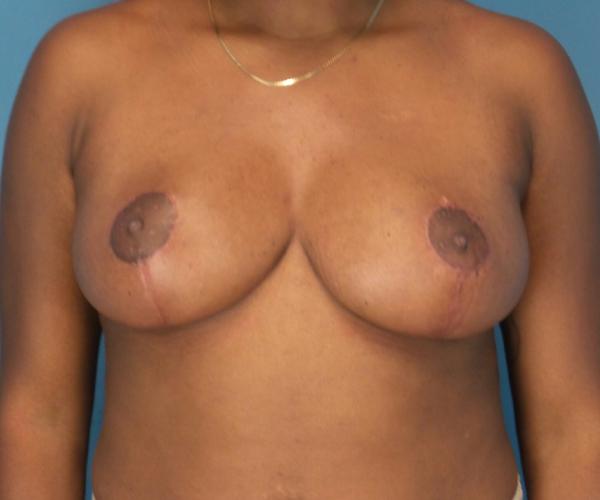 Crispin Plastic Surgery breast reduction after — Atlanta, GA