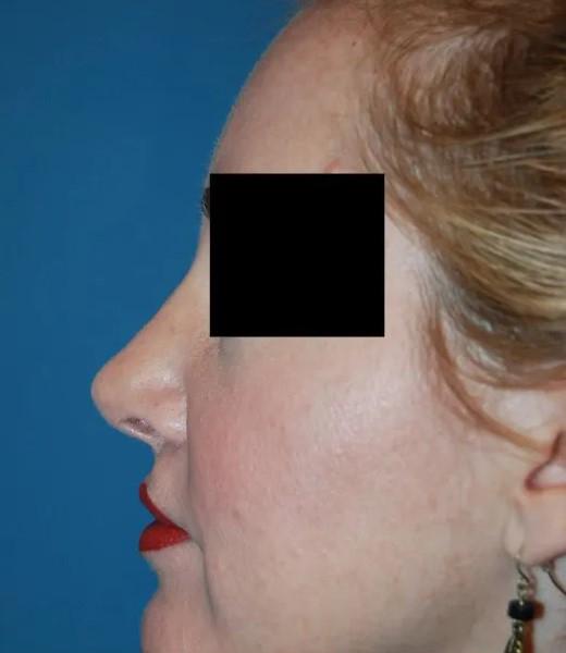 Ethnic Rhinoplasty after at Crispin Plastic Surgery in Atlanta, GA