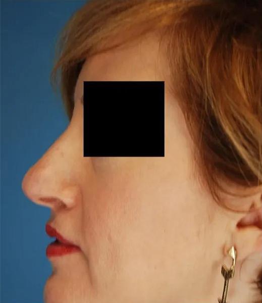 Ethnic Rhinoplasty before at Crispin Plastic Surgery in Atlanta, GA