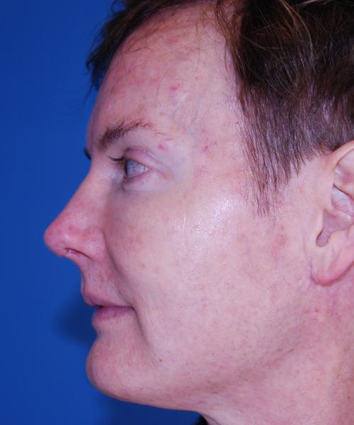 Crispin Plastic Surgery rhinoplasty after — Atlanta, GA