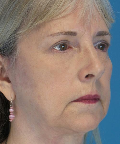 Crispin Plastic Surgery blepharoplasty after — Atlanta, GA