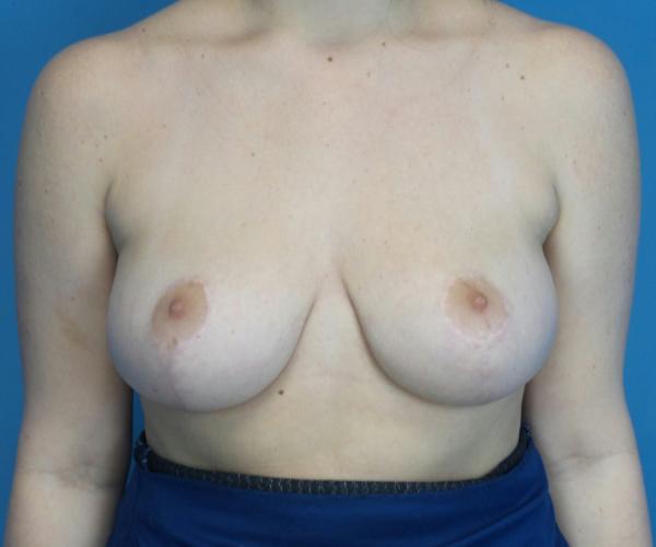 Breast Reduction after at Crispin Plastic Surgery in Atlanta, GA