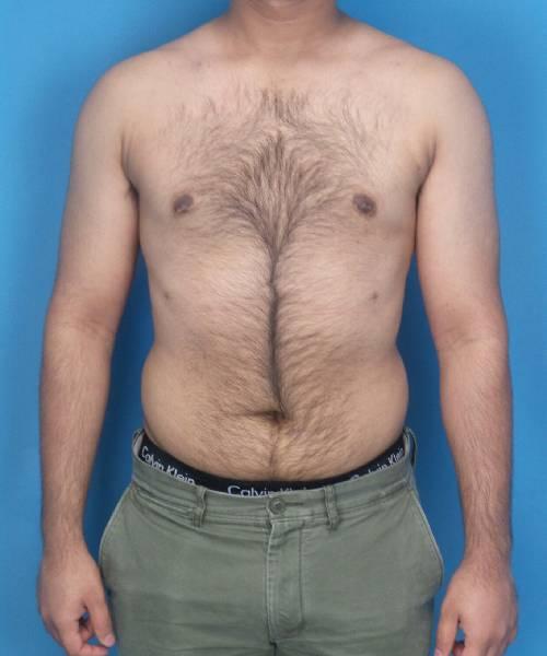 Crispin Plastic Surgery gynecomastia after — Atlanta, GA