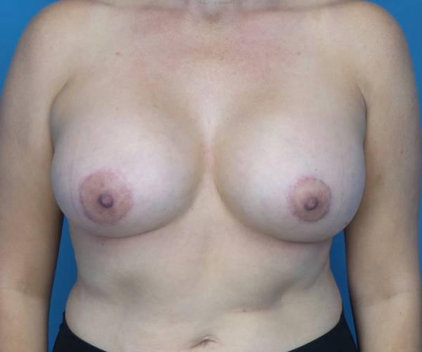 Crispin Plastic Surgery breast lift after — Atlanta, GA