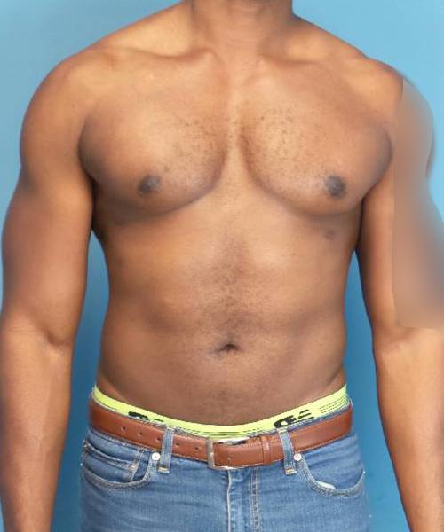 Crispin Plastic Surgery gynecomastia after — Atlanta, GA