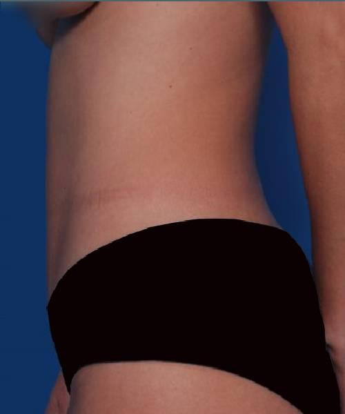 Liposuction after at Crispin Plastic Surgery in Atlanta, GA