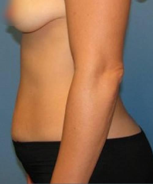 Liposuction before at Crispin Plastic Surgery in Atlanta, GA