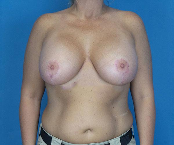 Crispin Plastic Surgery breast lift after — Atlanta, GA