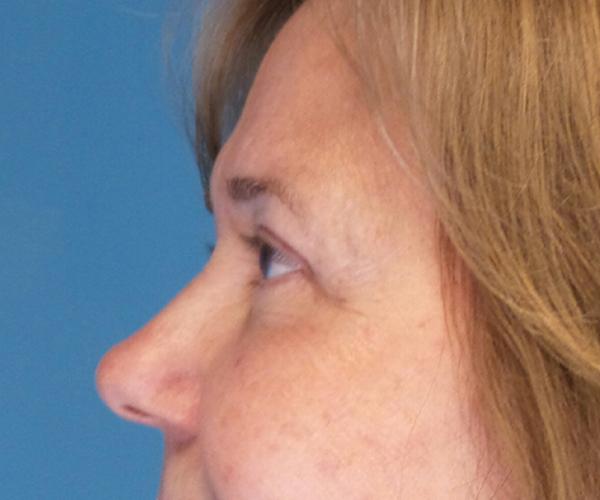Crispin Plastic Surgery blepharoplasty after — Atlanta, GA