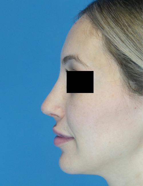 Crispin Plastic Surgery rhinoplasty after — Atlanta, GA