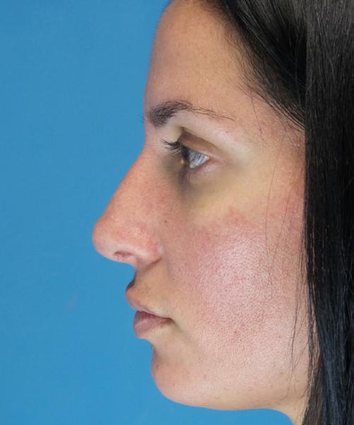 Crispin Plastic Surgery rhinoplasty after — Atlanta, GA