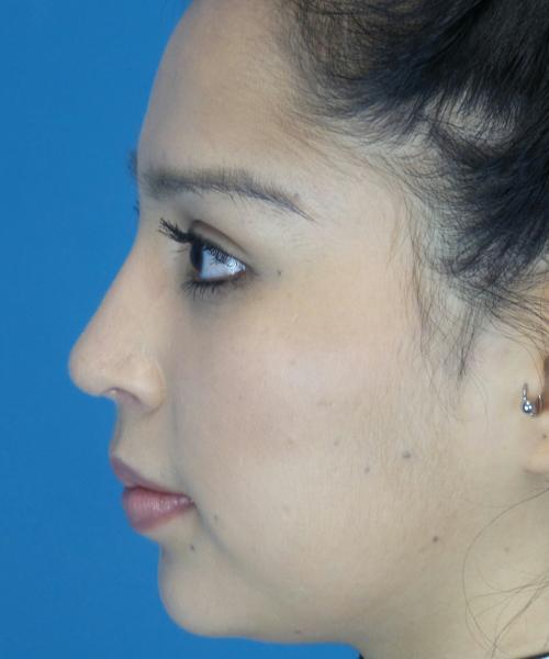 Crispin Plastic Surgery rhinoplasty after — Atlanta, GA