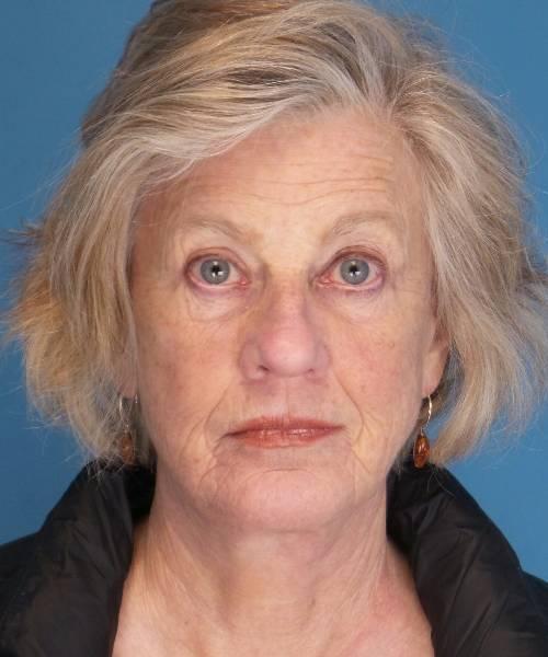 Crispin Plastic Surgery facelift after — Atlanta, GA