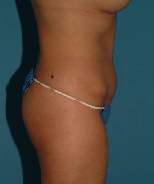 Crispin Plastic Surgery tummy tuck after — Atlanta, GA