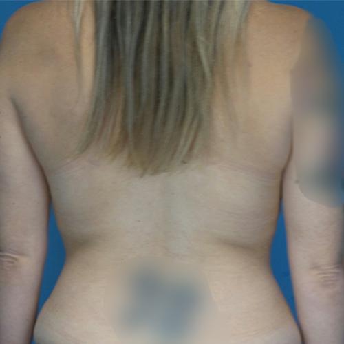 Crispin Plastic Surgery liposuction after — Atlanta, GA