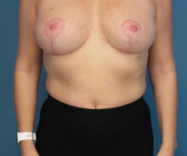 Crispin Plastic Surgery breast lift after — Atlanta, GA