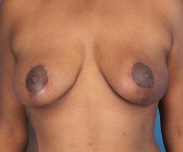 Crispin Plastic Surgery breast reduction after — Atlanta, GA