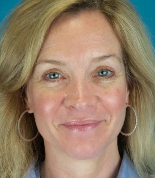 Crispin Plastic Surgery blepharoplasty after — Atlanta, GA
