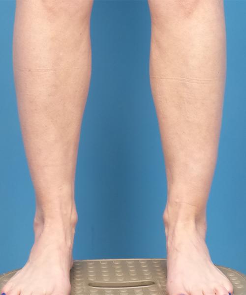 Liposuction before at Crispin Plastic Surgery in Atlanta, GA