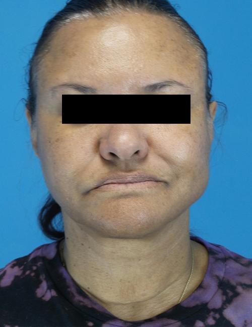 Crispin Plastic Surgery neck lift after — Atlanta, GA