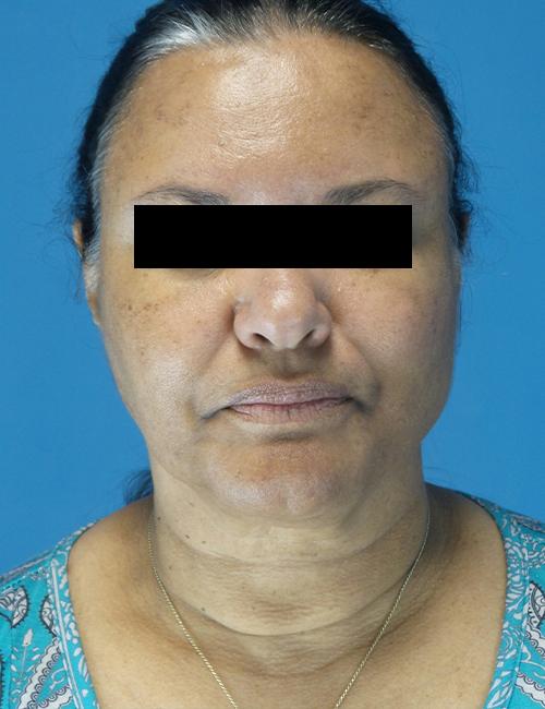 Neck Lift before at Crispin Plastic Surgery in Atlanta, GA