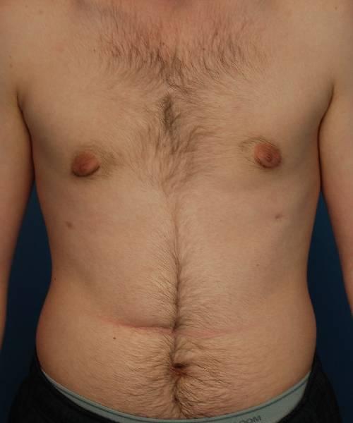 Crispin Plastic Surgery gynecomastia after — Atlanta, GA