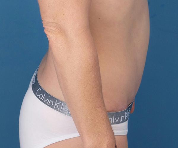 Crispin Plastic Surgery tummy tuck after — Atlanta, GA