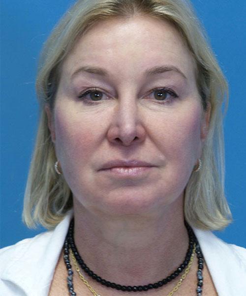 Neck Lift after at Crispin Plastic Surgery in Atlanta, GA