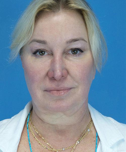 Neck Lift before at Crispin Plastic Surgery in Atlanta, GA