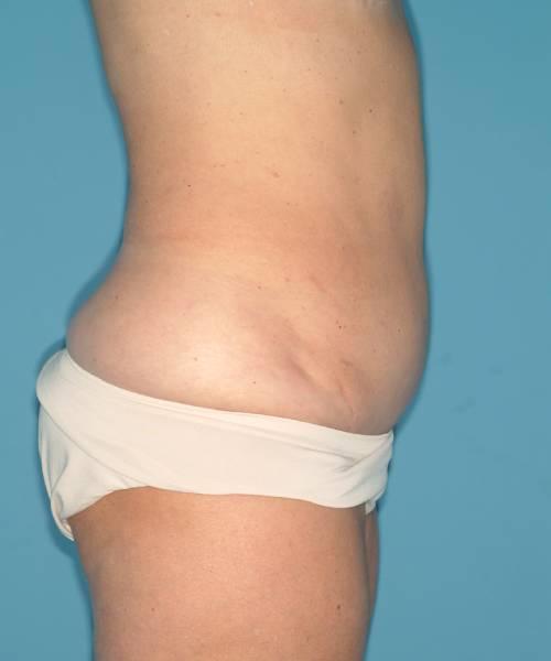 Crispin Plastic Surgery tummy tuck after — Atlanta, GA