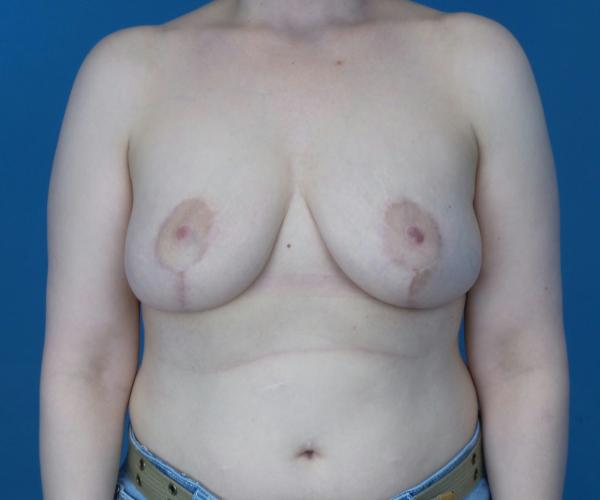 Breast Reduction after at Crispin Plastic Surgery in Atlanta, GA