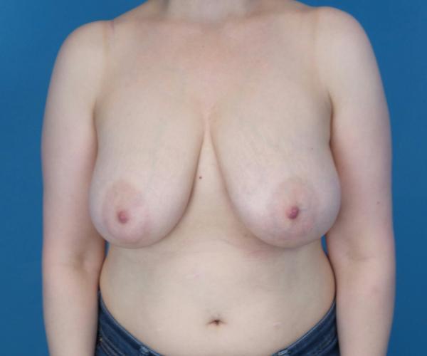 Breast Reduction before at Crispin Plastic Surgery in Atlanta, GA