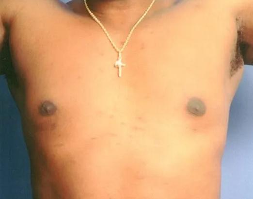 Gynecomastia Surgery after at Crispin Plastic Surgery in Atlanta, GA