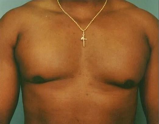 Gynecomastia Surgery before at Crispin Plastic Surgery in Atlanta, GA
