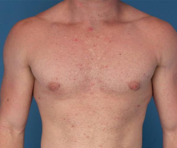 Crispin Plastic Surgery gynecomastia after — Atlanta, GA