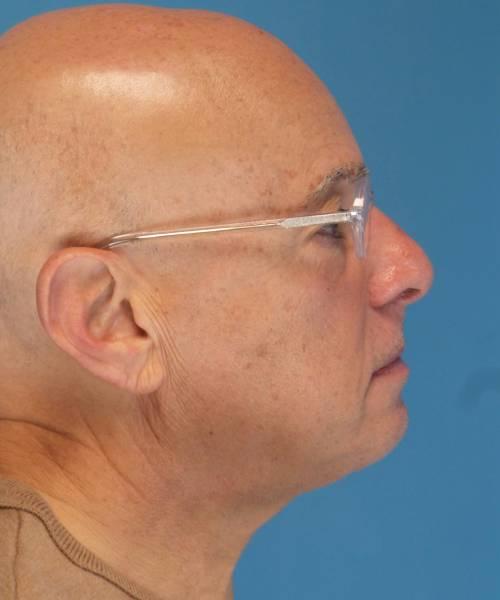 Crispin Plastic Surgery facelift after — Atlanta, GA
