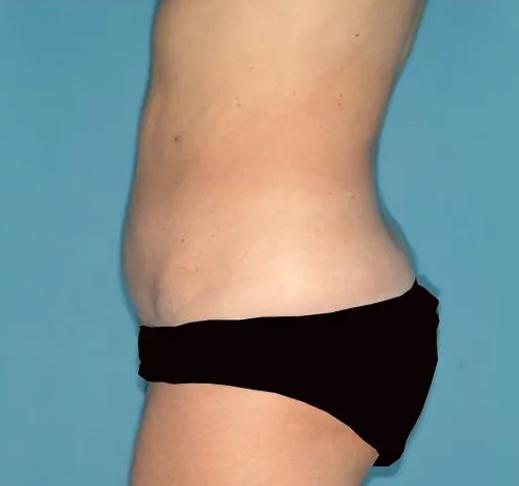 Tummy Tuck after at Crispin Plastic Surgery in Atlanta, GA